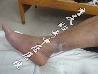 右小腿外伤破溃流脓