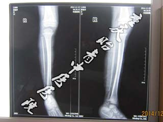 2岁小女孩腓骨骨髓炎