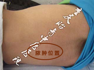 21岁小伙腰腹痛4月余