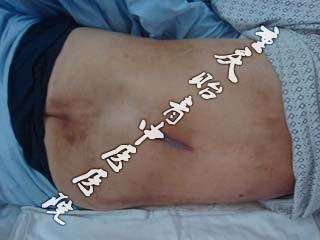 73岁魏先生胸椎结核