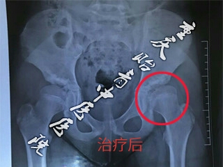 江苏4岁小女孩左侧股